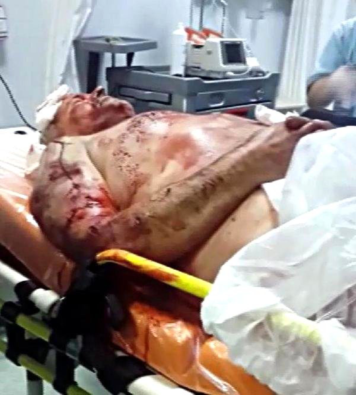 Bekçinin Köpek Saldırısında Parçalanan Kulağı Alındı