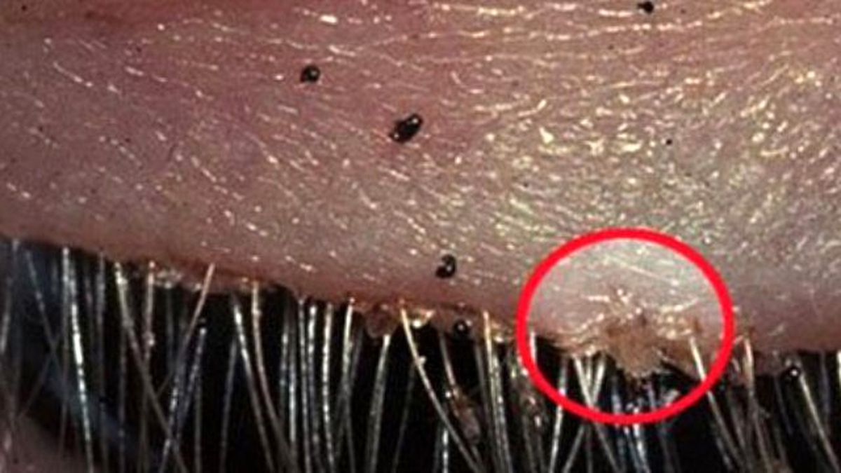 Gözünün İçinden 20 Tane Bit Çıktı!