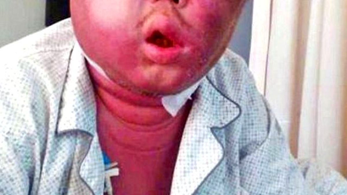 Sivrisineğin Isırdığı Adamın Kafası Balon Gibi Şişti