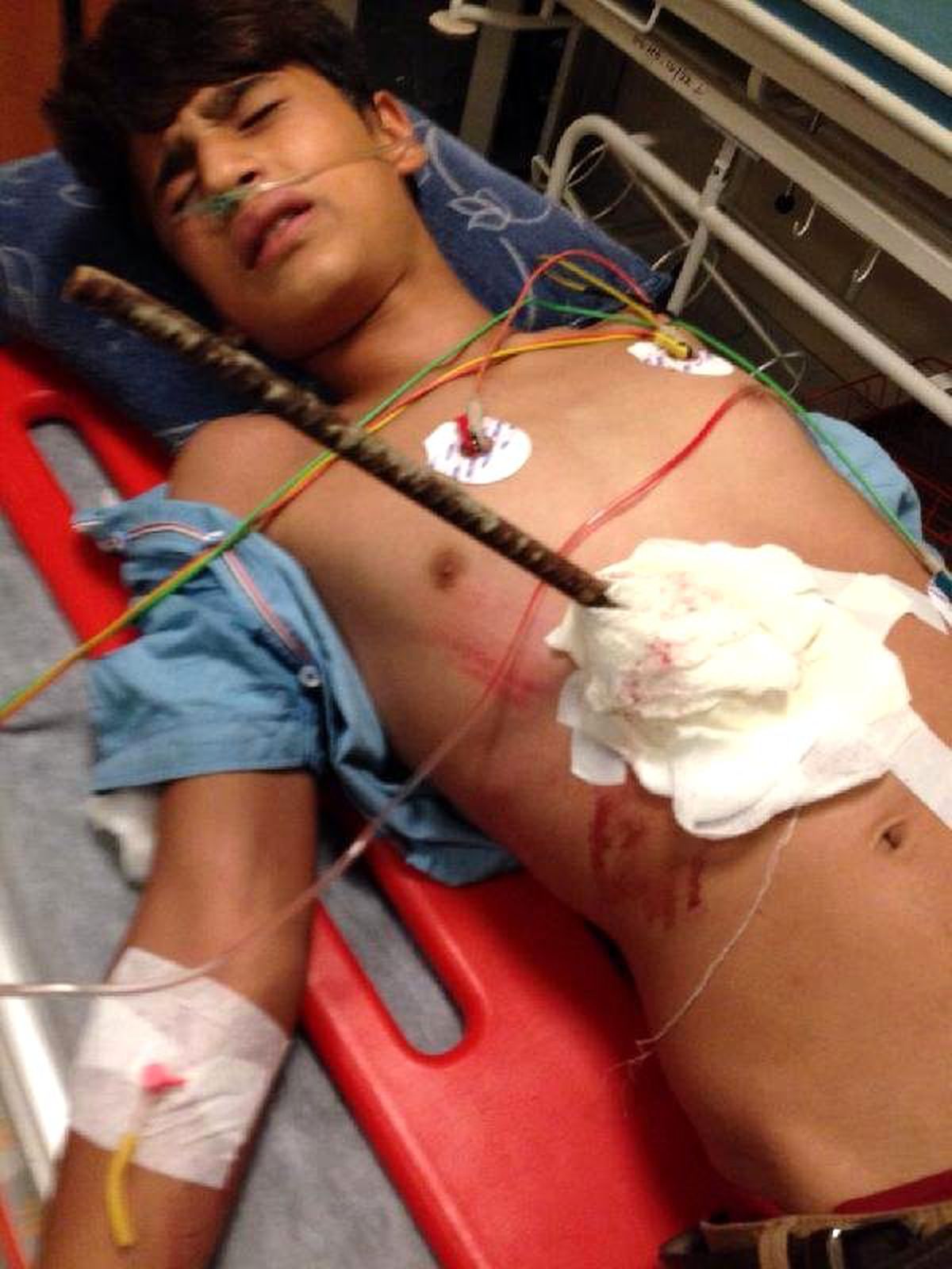 14 Yaşındaki Çocuğun Karnına Saplanan 2 Metrelik Demir Çubuk, Belinden Çıktı