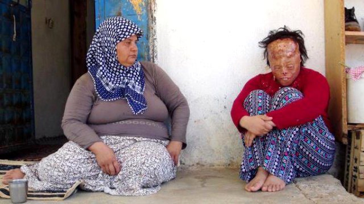 Yüz Nakli Bekleyen Leyla, Önce Psikolojisinin Düzelmesini İstiyor