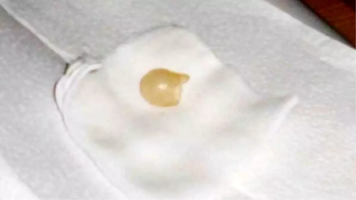 Süt Emerken Biberon Ucunu Yutan \'Zeytin\' Ölümden Döndü