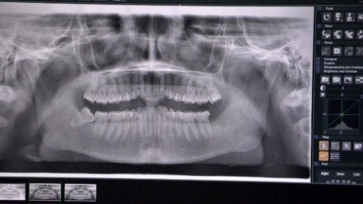 Gazi Hastanesinde Dental Radyoloji Ünitesi Açıldı