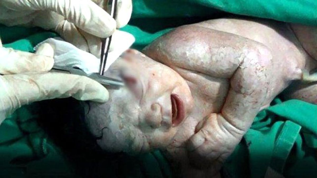 İnanılmaz Olay! Anne Karnından Çıkarılıp, Ameliyat Edildi