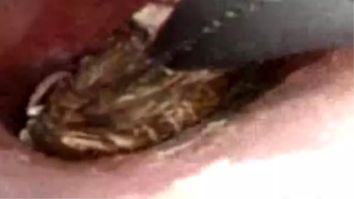 Genç Kadının Kulağından Örümcek Çıktı!