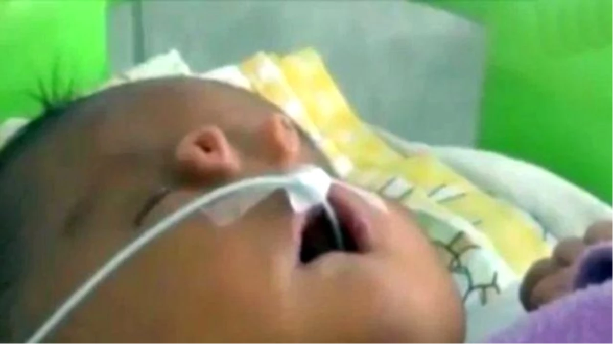 Peru\'da Doğan Bebeğin Burnu Görenleri Hayrete Düşürüyor