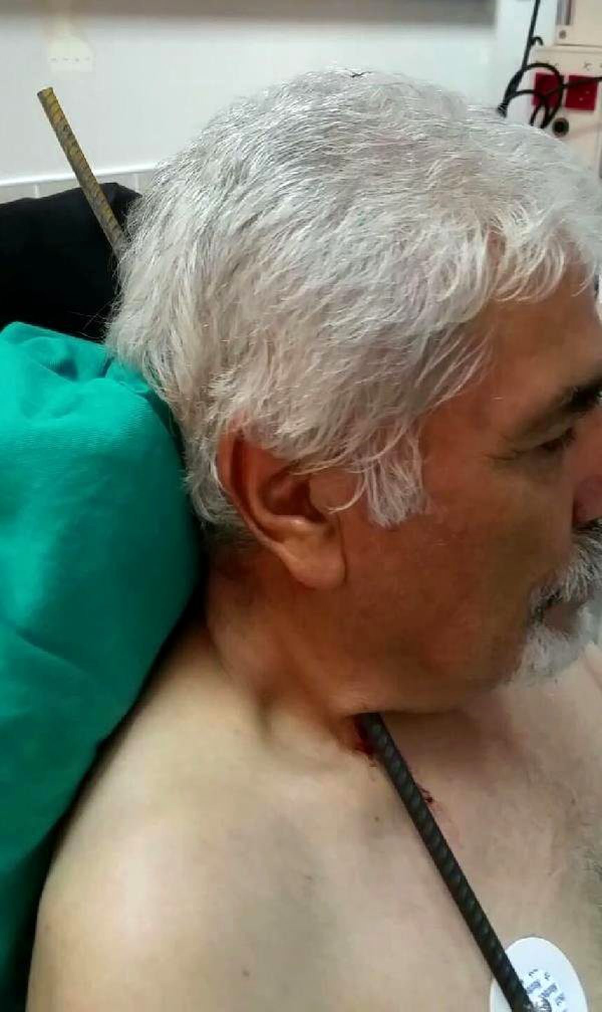 Boynuna Saplanan 6 Metrelik İnşaat Demiri, Ameliyatla Çıkarıldı
