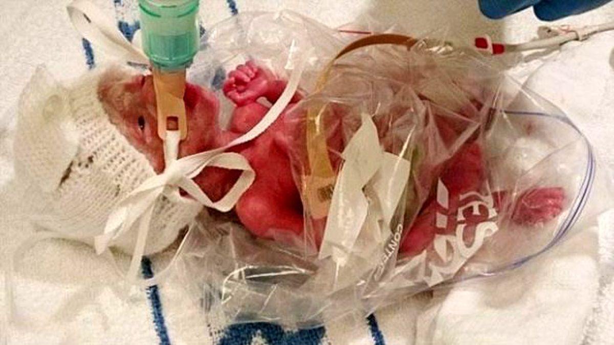 Erken Doğan Bebek Sandviç Poşetiyle Isıtılarak Kurtarıldı