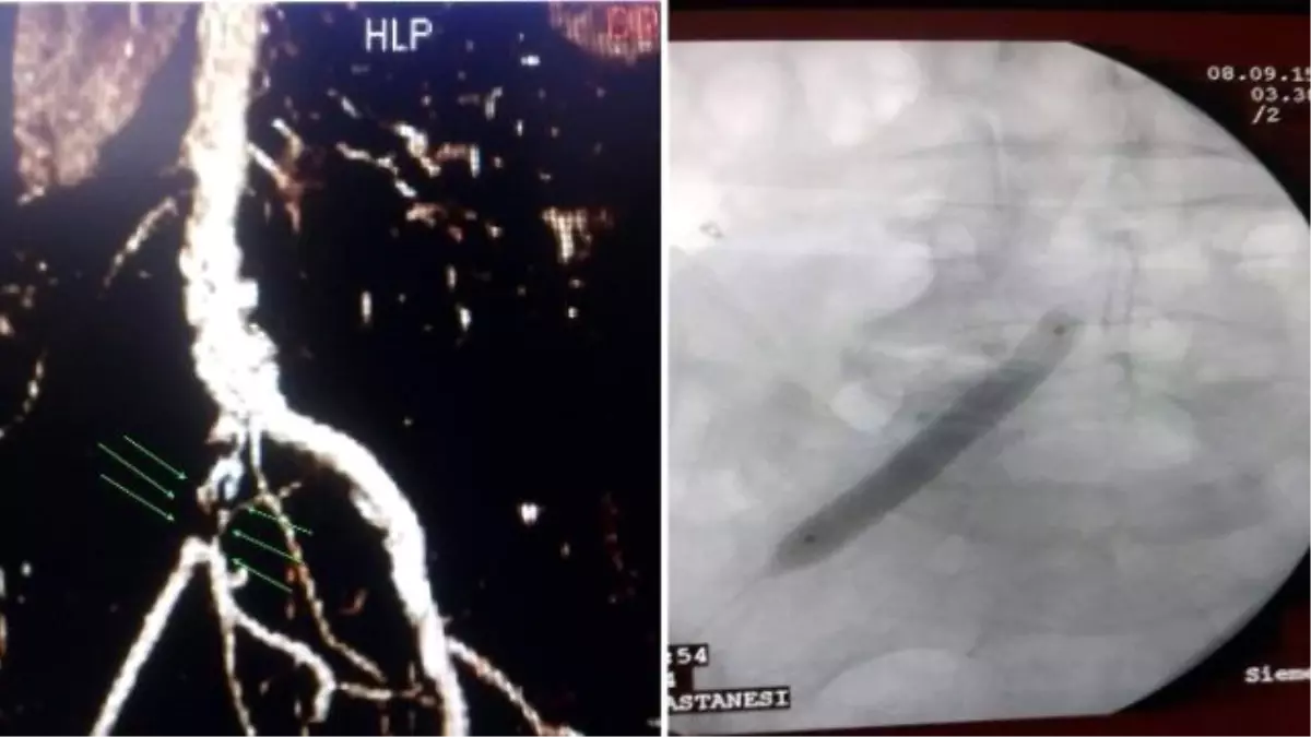 Nevşehir\'de İlk Defa Bacak Ana Atardamarına Balon ve Stent Uygulaması Yapıldı