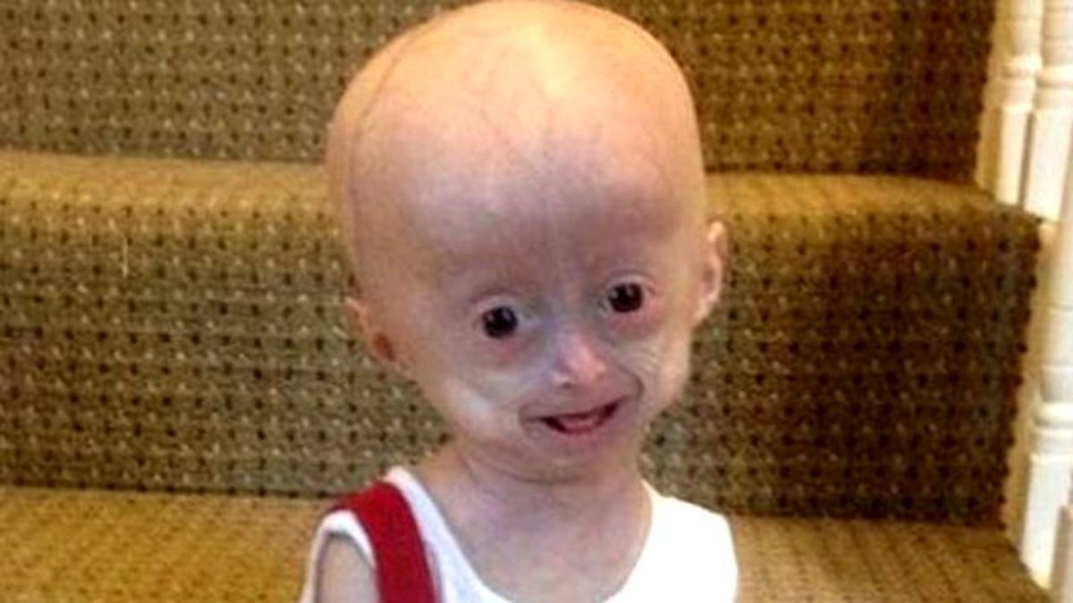 5 Yaşındaki Kız Normalden 8 Kat Daha Hızlı Yaşlanıyor!