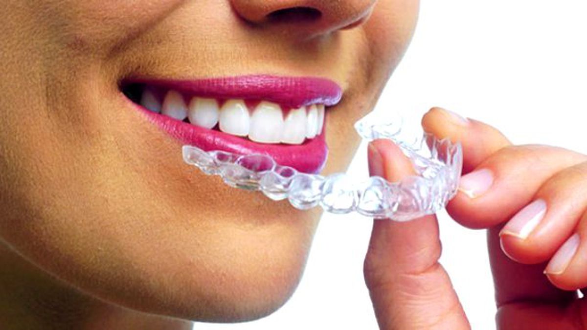 Diş Telleri Tarihe Karışıyor