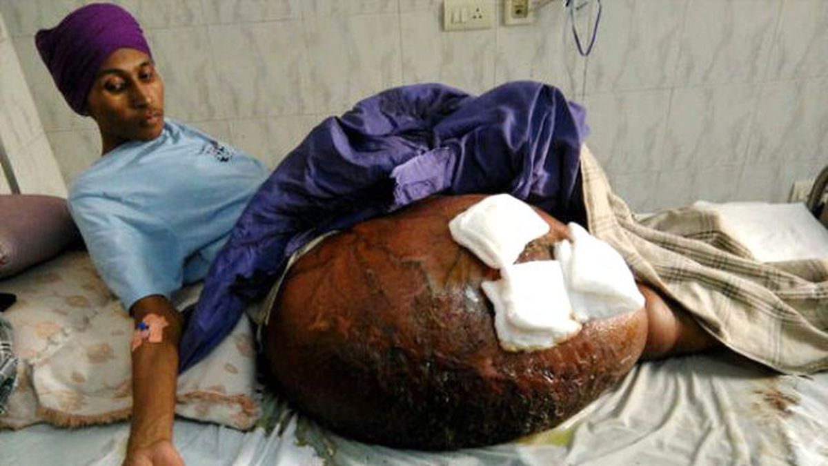 Doktorlar Şaştı Kaldı, Tümör Hastadan Ağır Çıktı