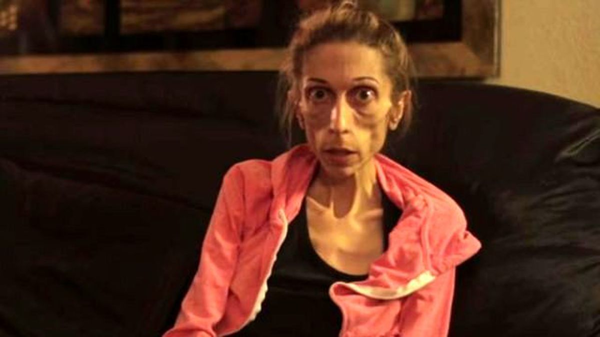 18 Kiloya Düşen Kadın Ölümün Kıyısından Döndü