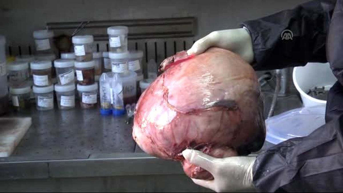 Ameliyattan Korkan Kadın Karnında 6 Kilogramlık Tümörle 8 Yıl Yaşadı