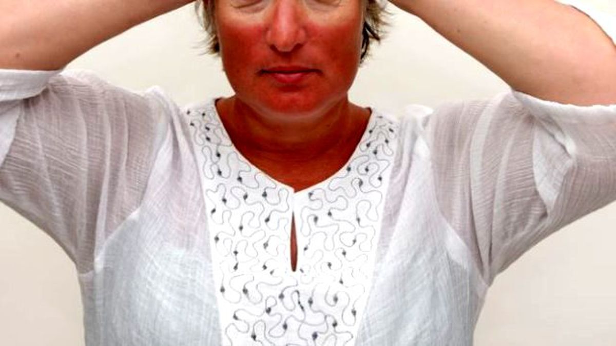 Hintli Genç, Evlilik Teklifini Reddeden Rus Kızın Yüzüne Asit Döktü