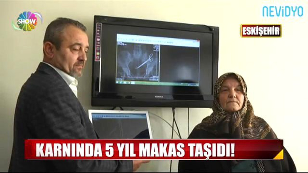 Karnında Unutulan Makasla 5 Yıl Yaşadı