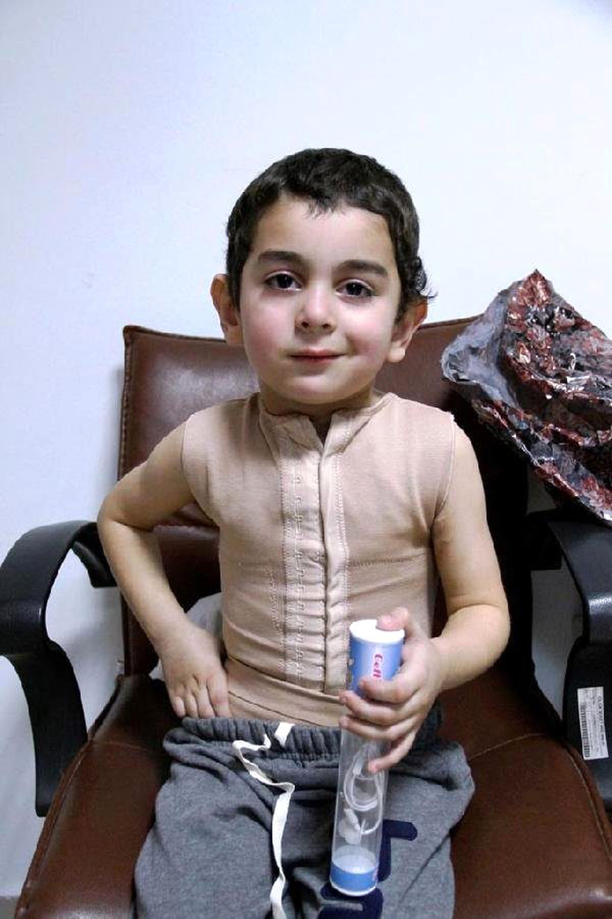 Süt Kazanına Düşen Berat İyileşiyor