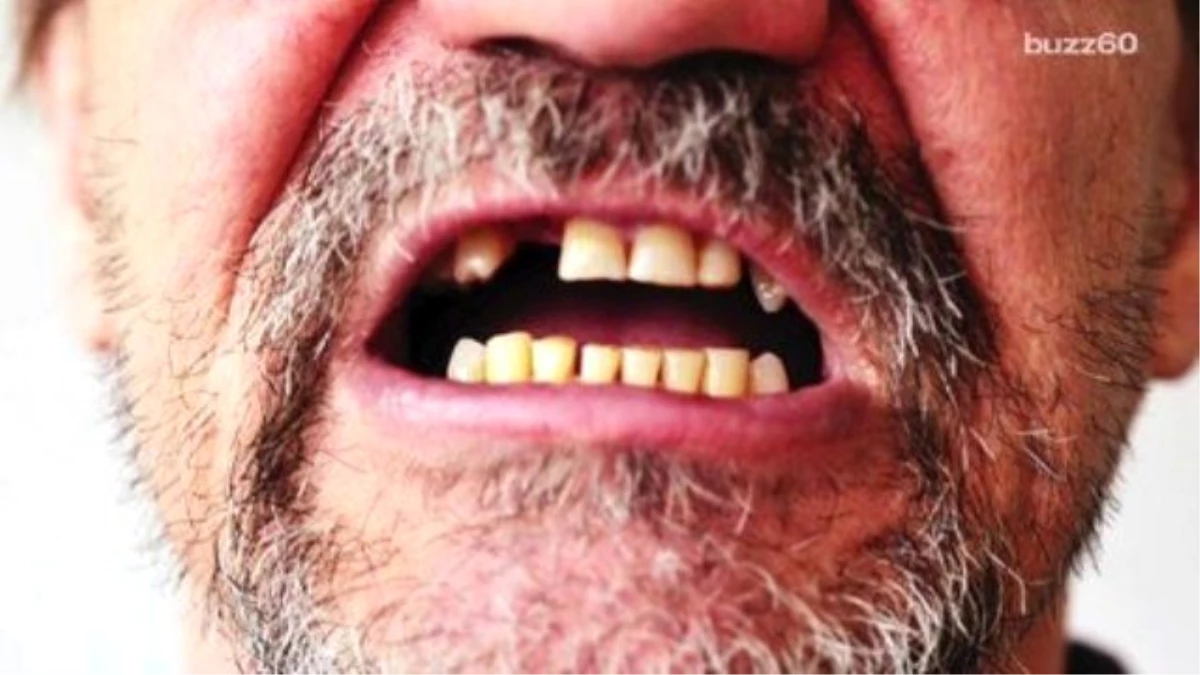 Brits Actually Have Better Teeth Than Americans