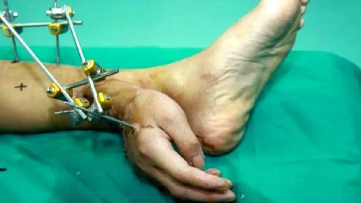 Kazada Kopan Elini Kurtarmak İçin Ayağına Diktiler