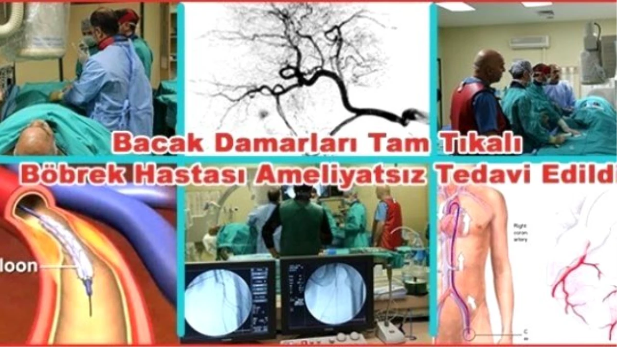 Diyaliz Hastasının Tıkalı Olan Bacağı Ameliyatsız Yöntemle Kesilmekten Kurtuldu