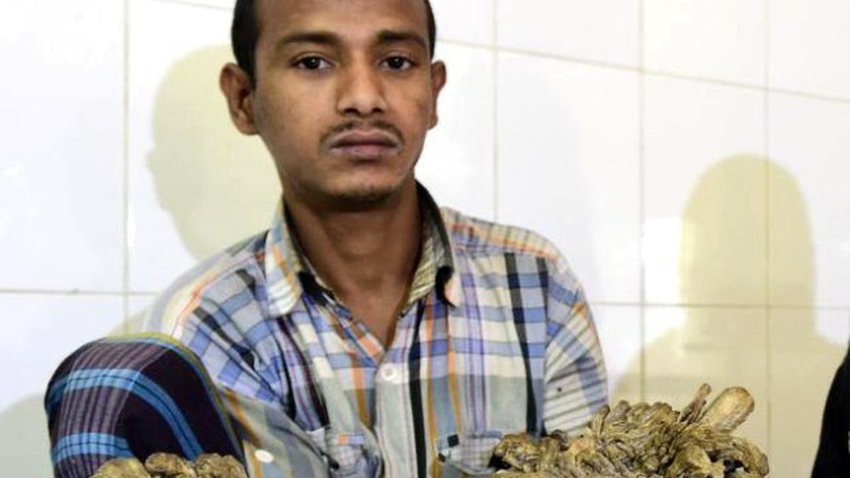 Ağaç Adam 16 Yıl Sonra Ameliyat Oluyor