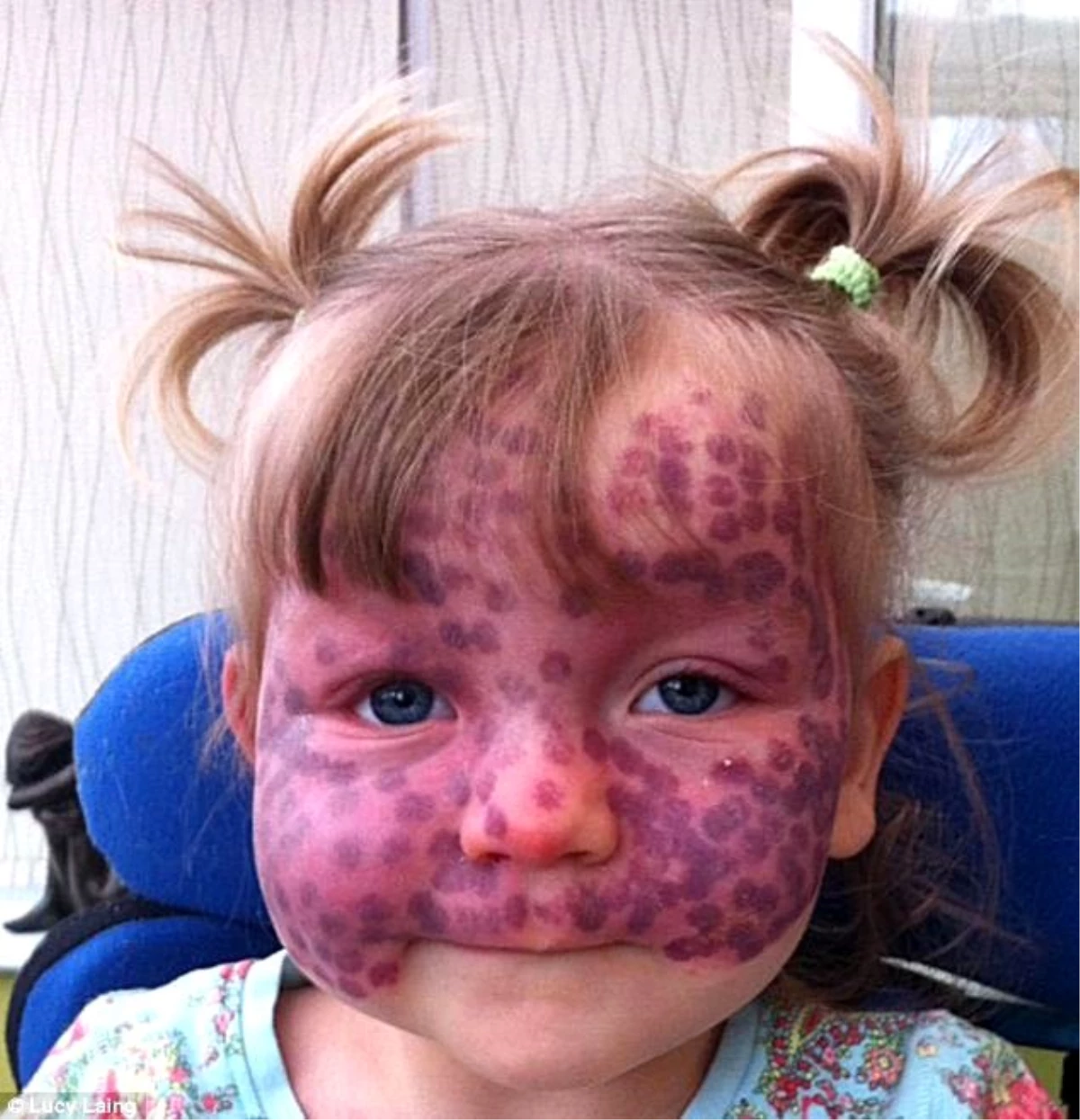 Yüzünde Lekelerle Doğan Küçük Kız Tedavi Ediliyor