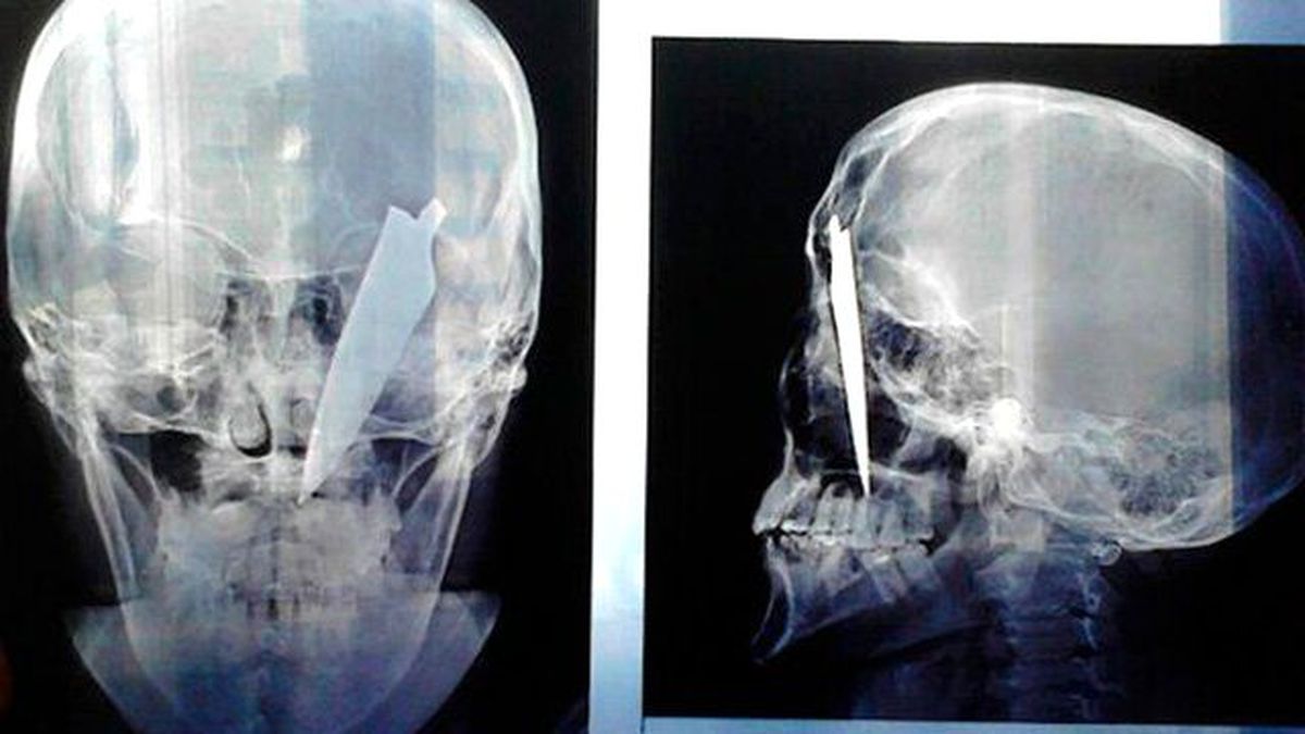 Genç Adam, Gözünün Üstünden Bıçaklandı Ölmedi