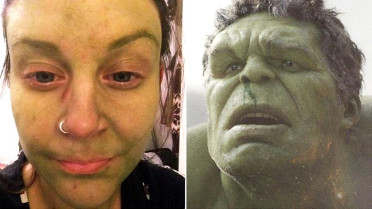 Genç Kadın Bronzlaşayım Derken Hulk\'a Döndü!