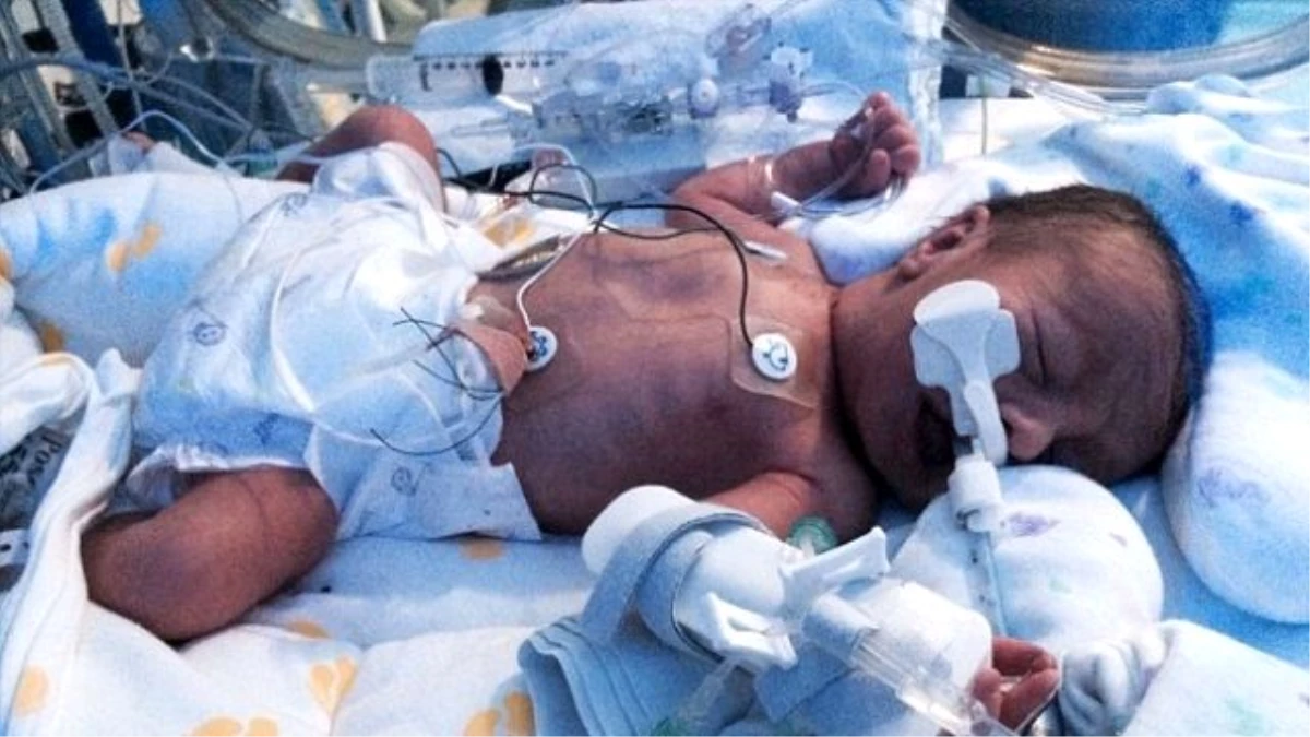 Plasentası Patlayan Kadının Bebeği Ölümden Döndü