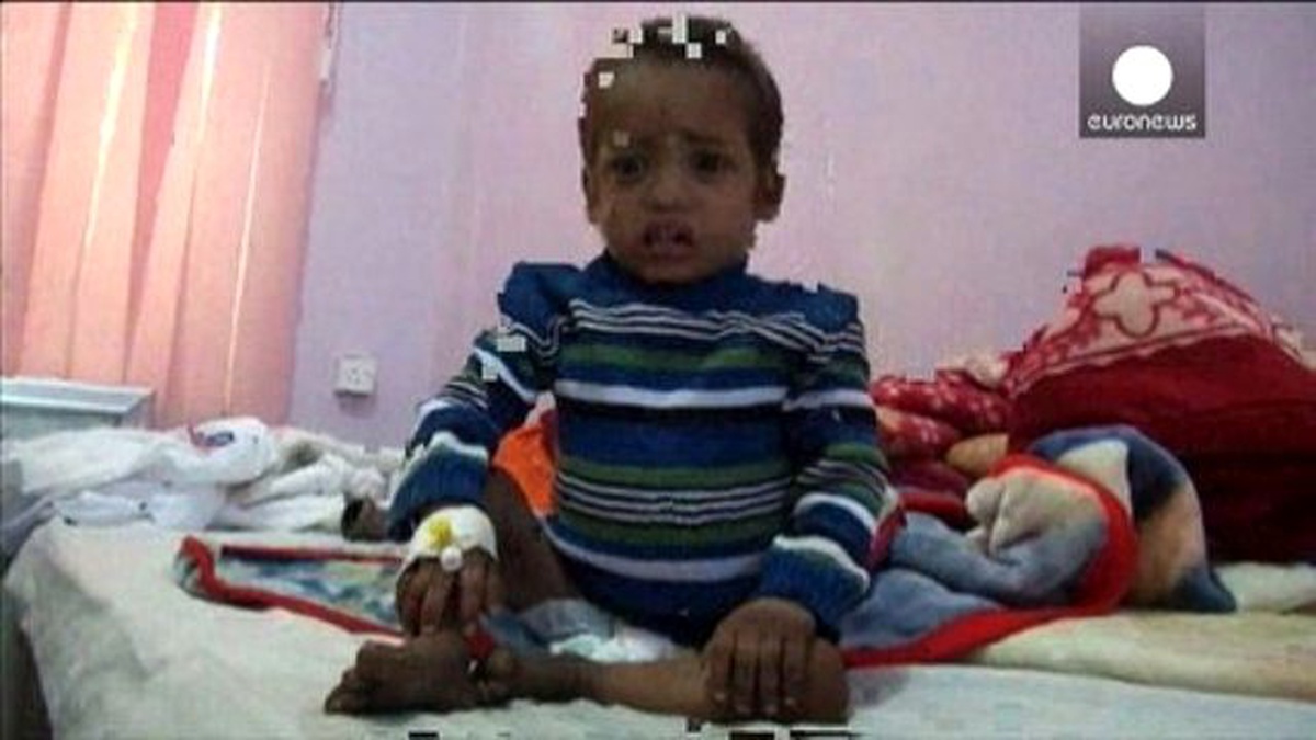 Yemen\'de Bir Milyondan Fazla Çocuk Zafiyet Tehlikesi Altında
