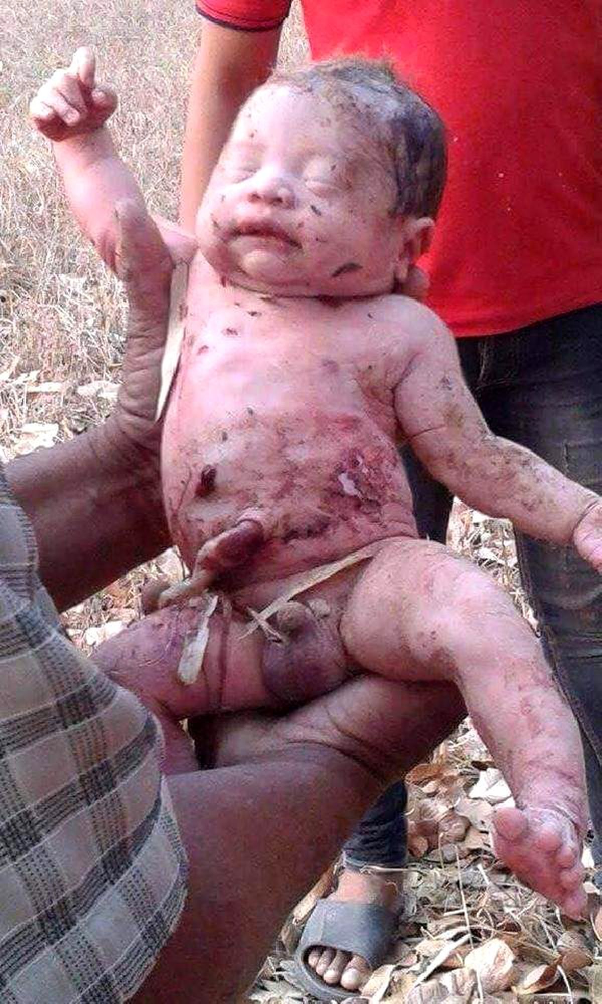 14 Yerinden Bıçaklanıp, Ormana Gömülen Bebek Hayata Tutundu