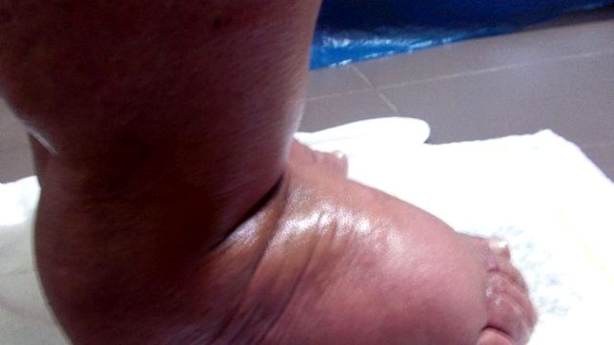 31 Yıl Sonra Fil Hastalığını Yendi, İlk Kez Ayakkabı Giydi