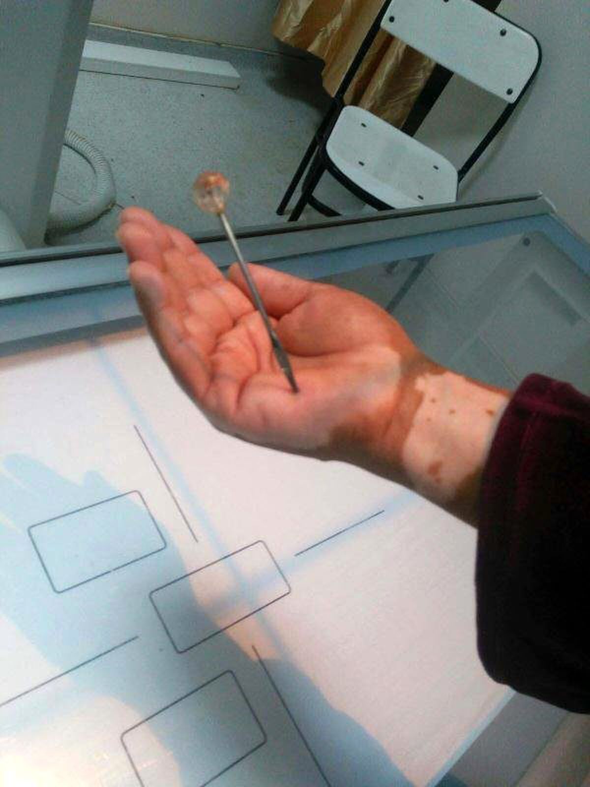Suriyeli Kadının Eline Batan Oya İğnesi Operasyonla Çıkarıldı