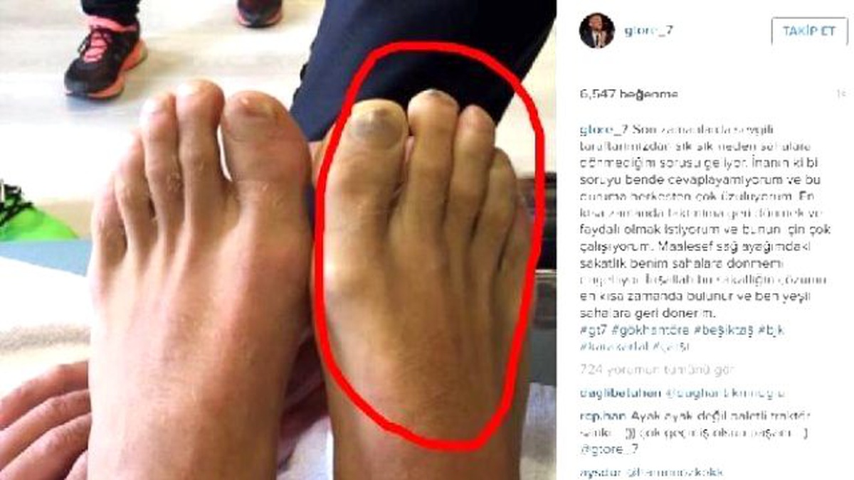 Gökhan Töre\'den Sakatlığı ile İlgili Açıklama