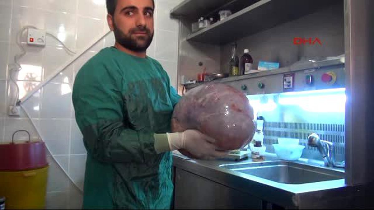 Batman Suriyeli 79 Yaşındaki Kadının Karnından 12 Kiloluk Kist Çıktı