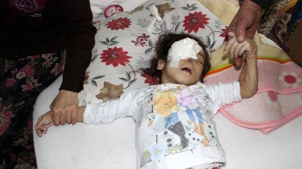 Acı Hissetmediği İçin Gözünü Çıkarıp Burnunu Parçalayan Minik Kız Öldü