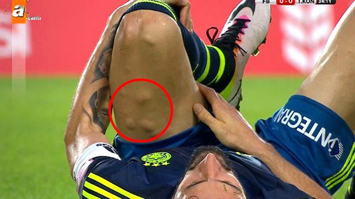 Mehmet Topal'ın Bacağındaki Şişlikler Dikkat Çekti