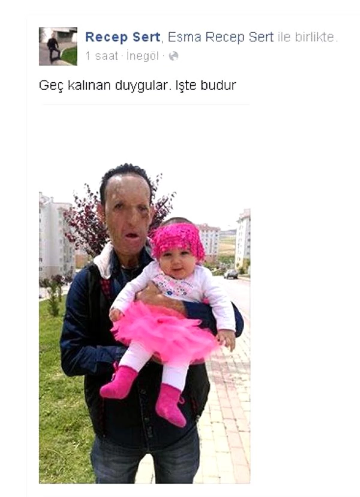 Yüz Nakilli Recep Sert, Kızıyla Fotoğrafını Paylaştı