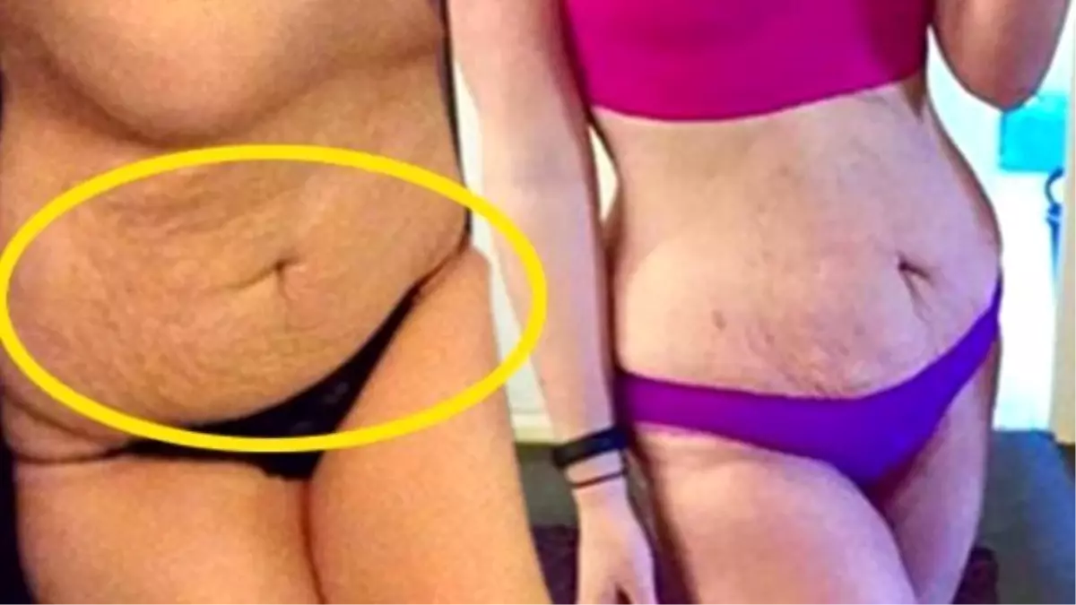 "Çatlaklar Benim Başarım" Diyen Isabella Hancock, 60 Kilo Verdi