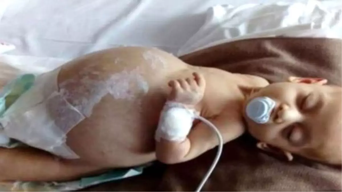 Sağlık Bakanlığı Seferber Oldu, Miray İçin İlaç Bulundu