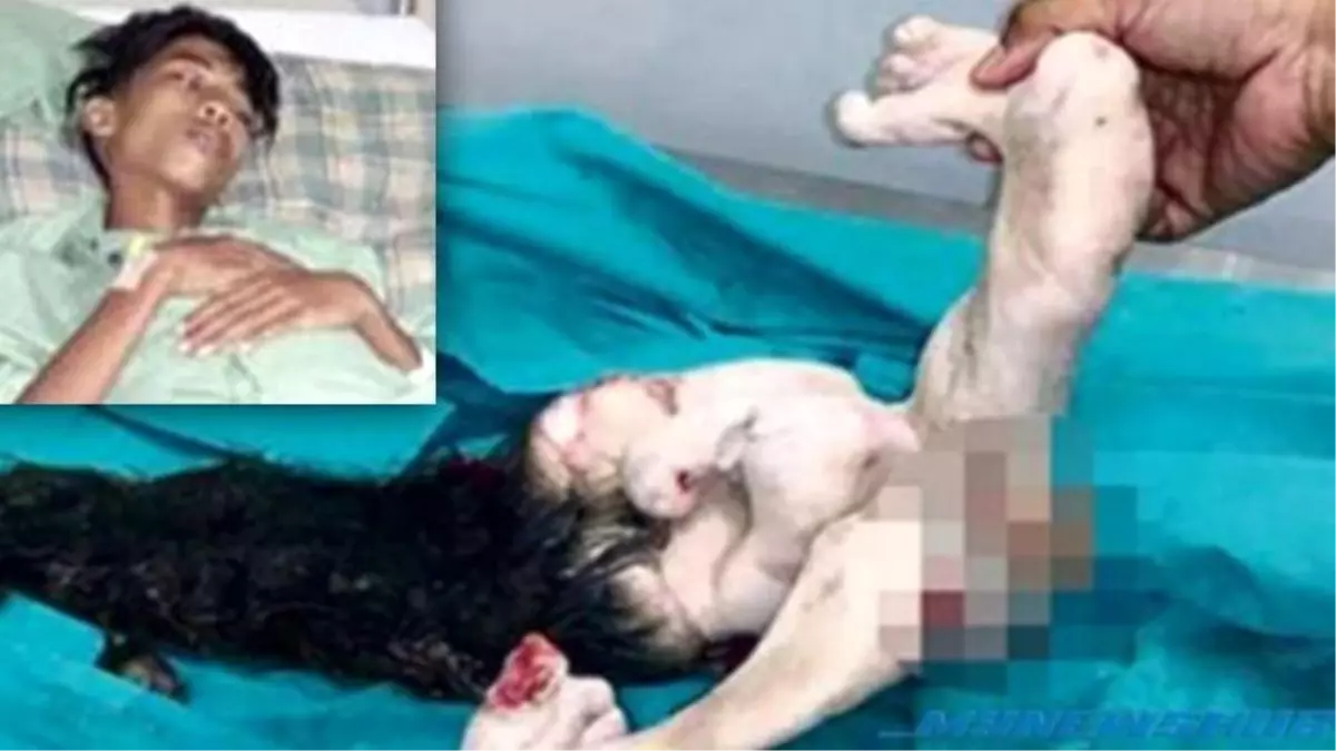 Malezyalı Gencin Karnından İkiz Parazit Kardeşi Çıkarıldı