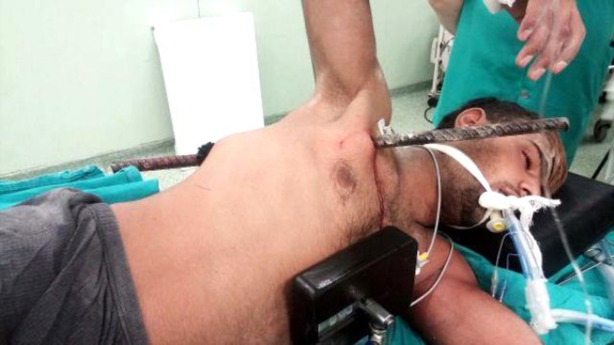 Göğsünden Girip, Sırtından Çıkan Demir Ameliyatla Çıkarıldı