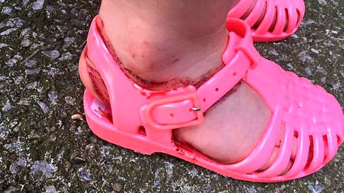 32 Liralık Sandalet Ayağını Bu Hale Getirdi