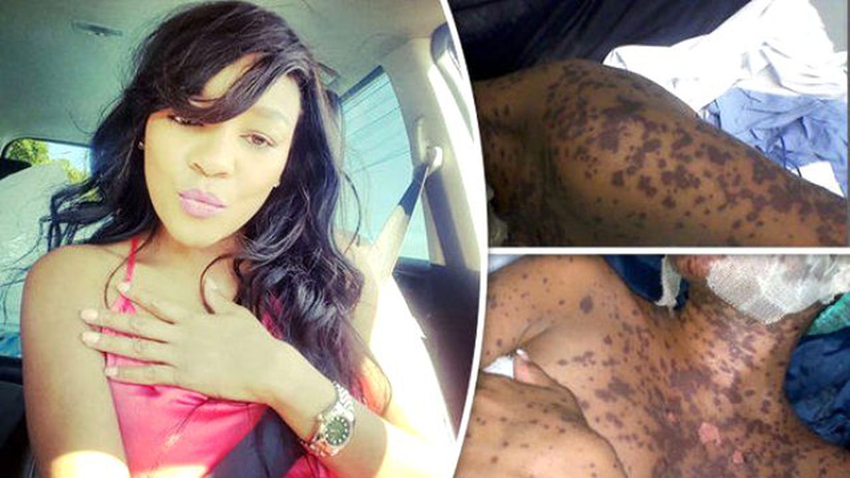 Antidepresan Kullanan Kadına Stevens Johnson Sendromu Teşhisi Konuldu