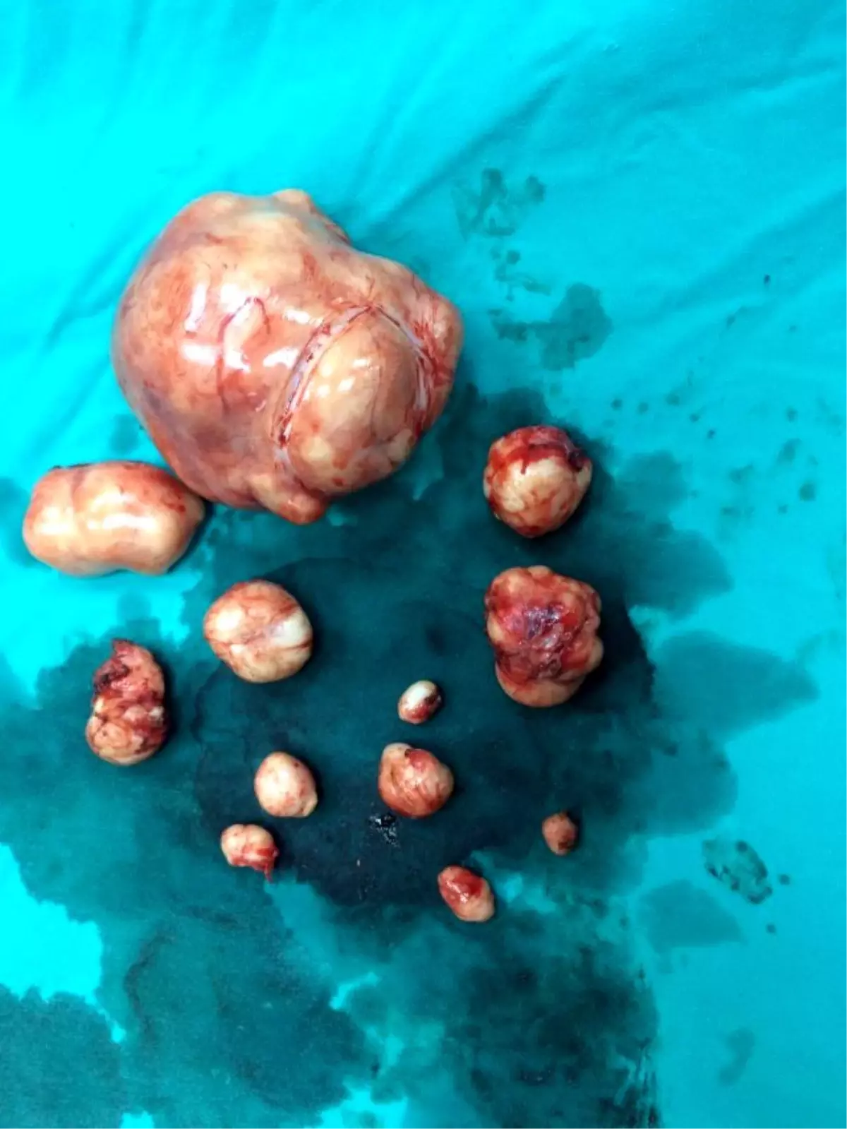 İki Kez Düşük Yapan Kadının Rahminden 12 Miyom Çıktı