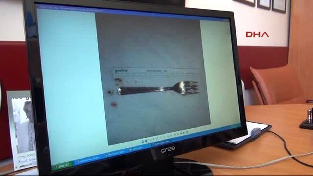 Konya Yuttuğu 15 Santimlik Metal Çatal, Ameliyatla Midesinden Çıkarıldı