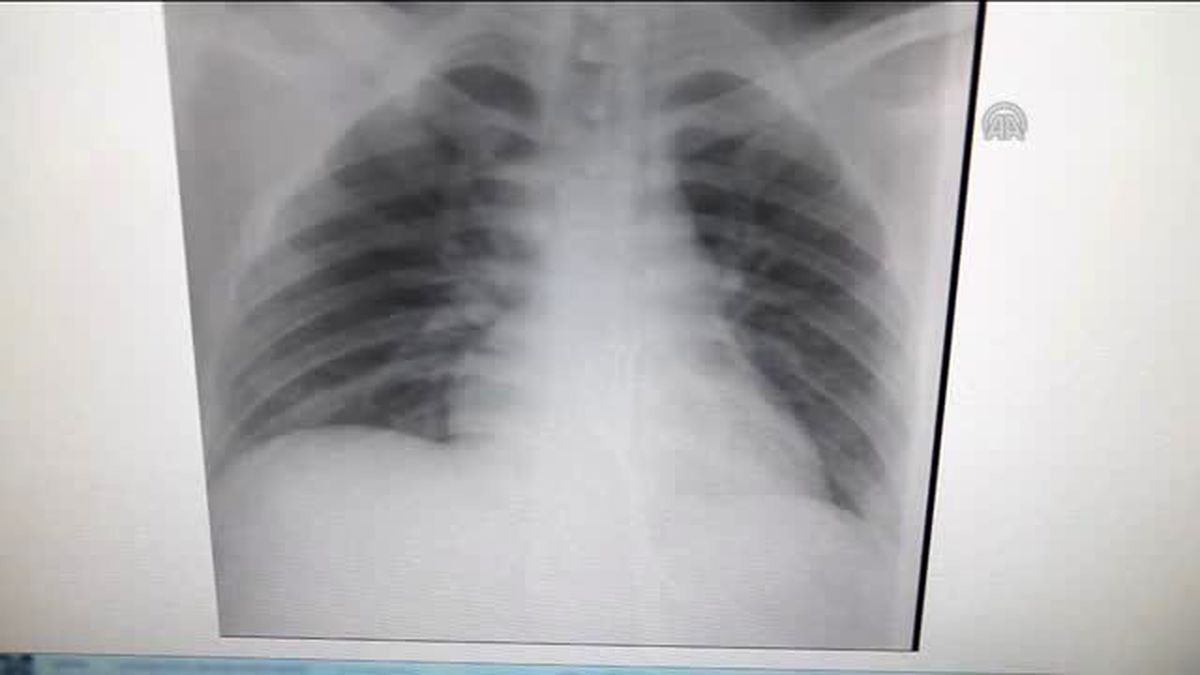 Midesinden 'Çatal' Çıkarıldı