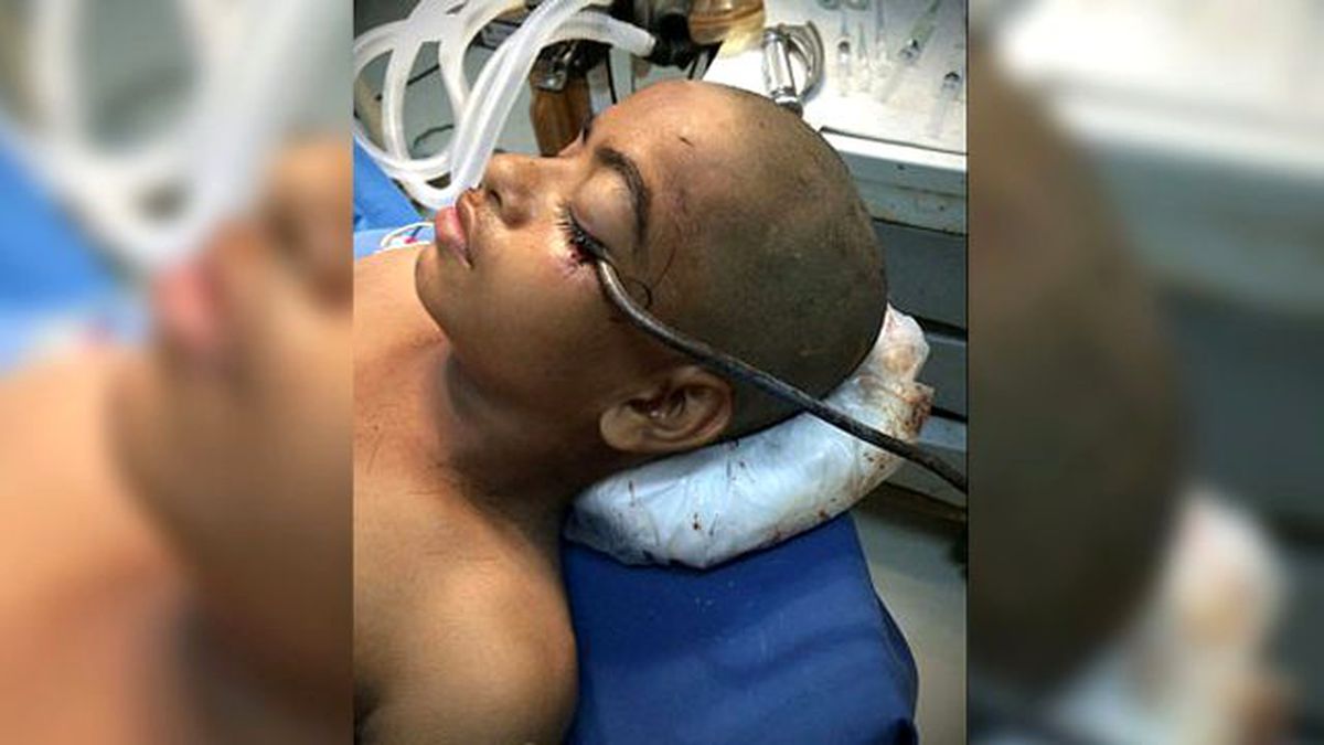 Küçük Çocuğun Gözünden Giren Demir Kanca, Beynine Saplandı