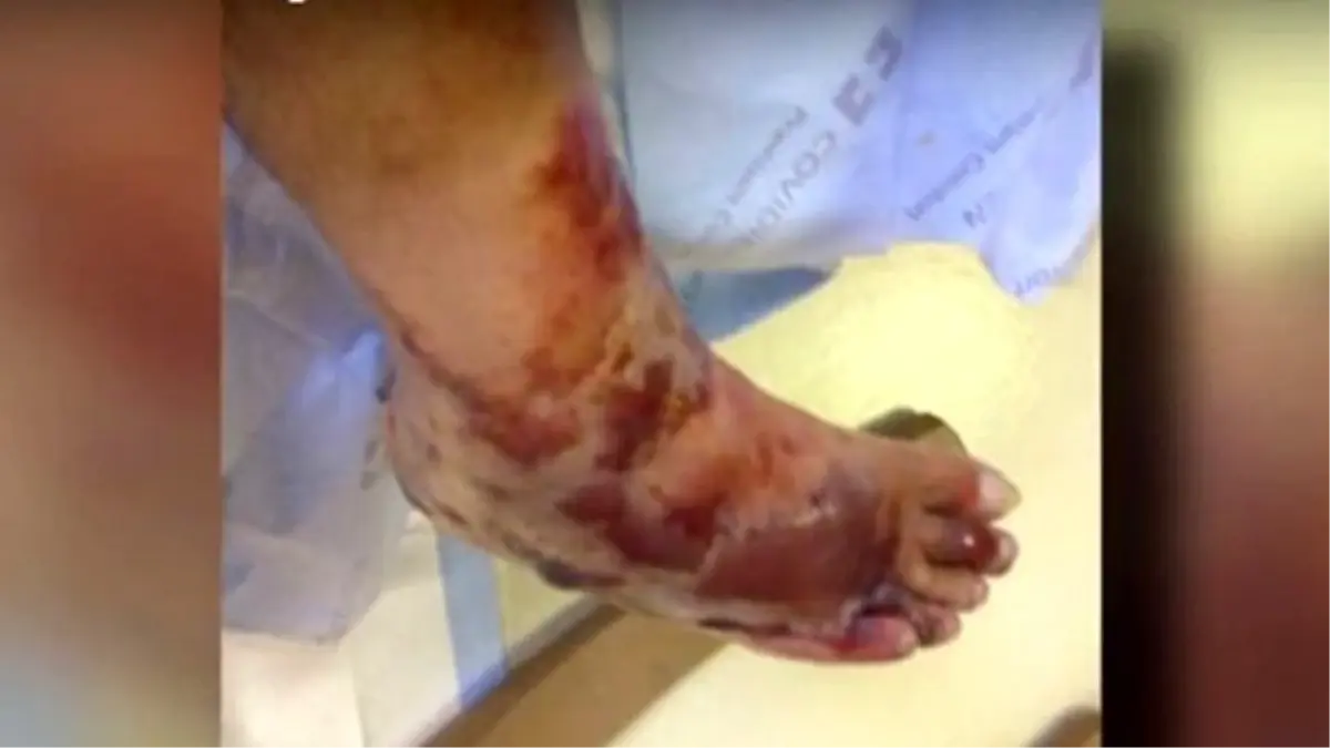 Ayağını Okyanusa Sokan Adamın 4 Gün Sonra Bacağı Kesildi