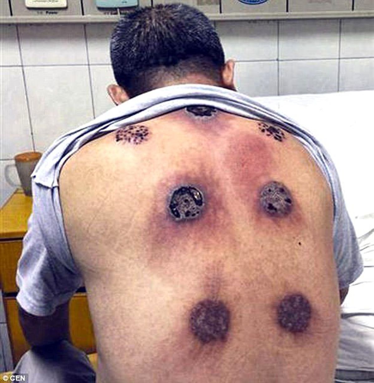 Bardak Çektirdi, Sırtı Yandı